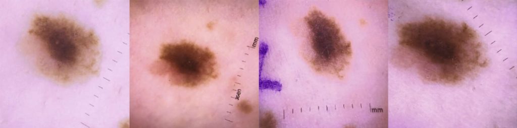 The presence of ruler markings correlated with the presence of tumors on the skin lesions dataset biases the model into classifying images with markers as tumors. Image adapted from Narla et al. (2018).